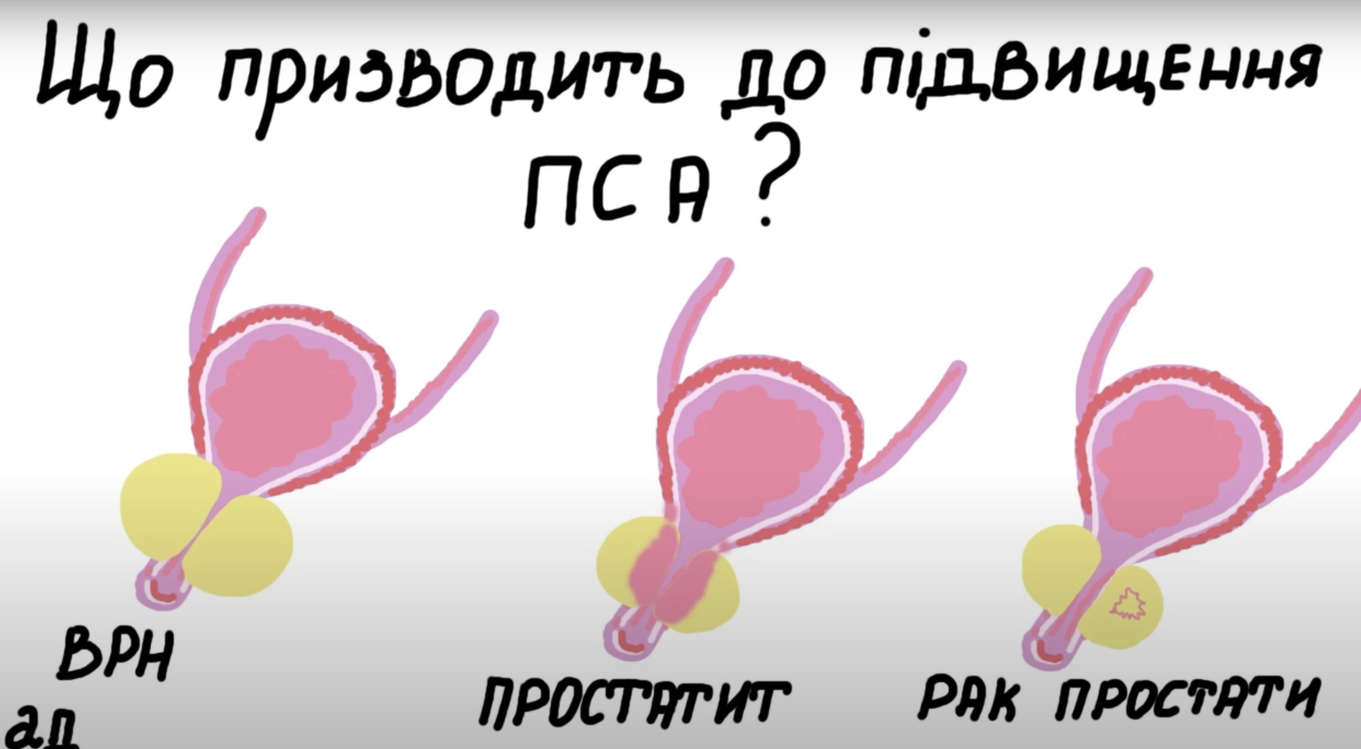 Простат специфічний антиген ( ПСА / PSA ) Аналіз крові на ПСА